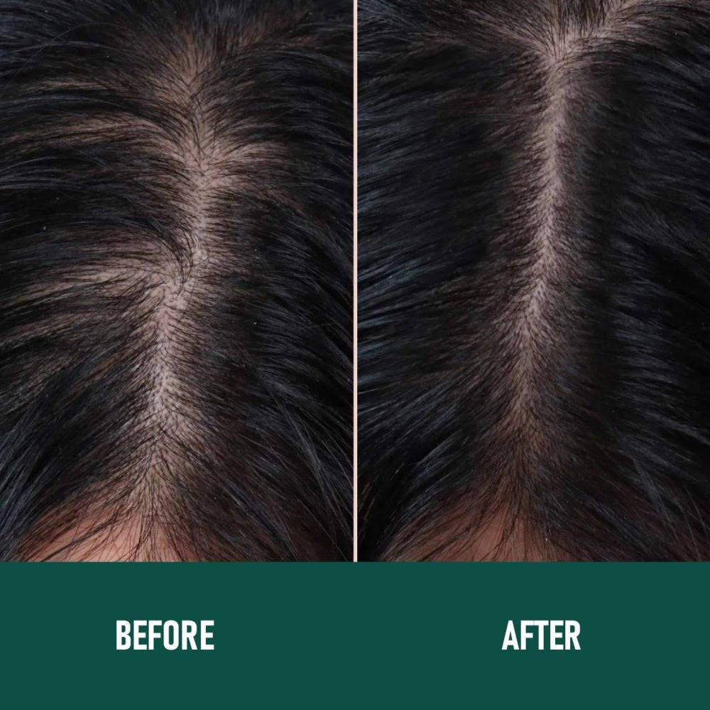 CH004 Mousse Anti - Chute de Cheveux au Minoxidil - Allomarc.com