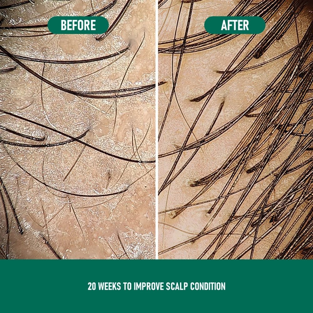 CH004 Mousse Anti - Chute de Cheveux au Minoxidil - Allomarc.com